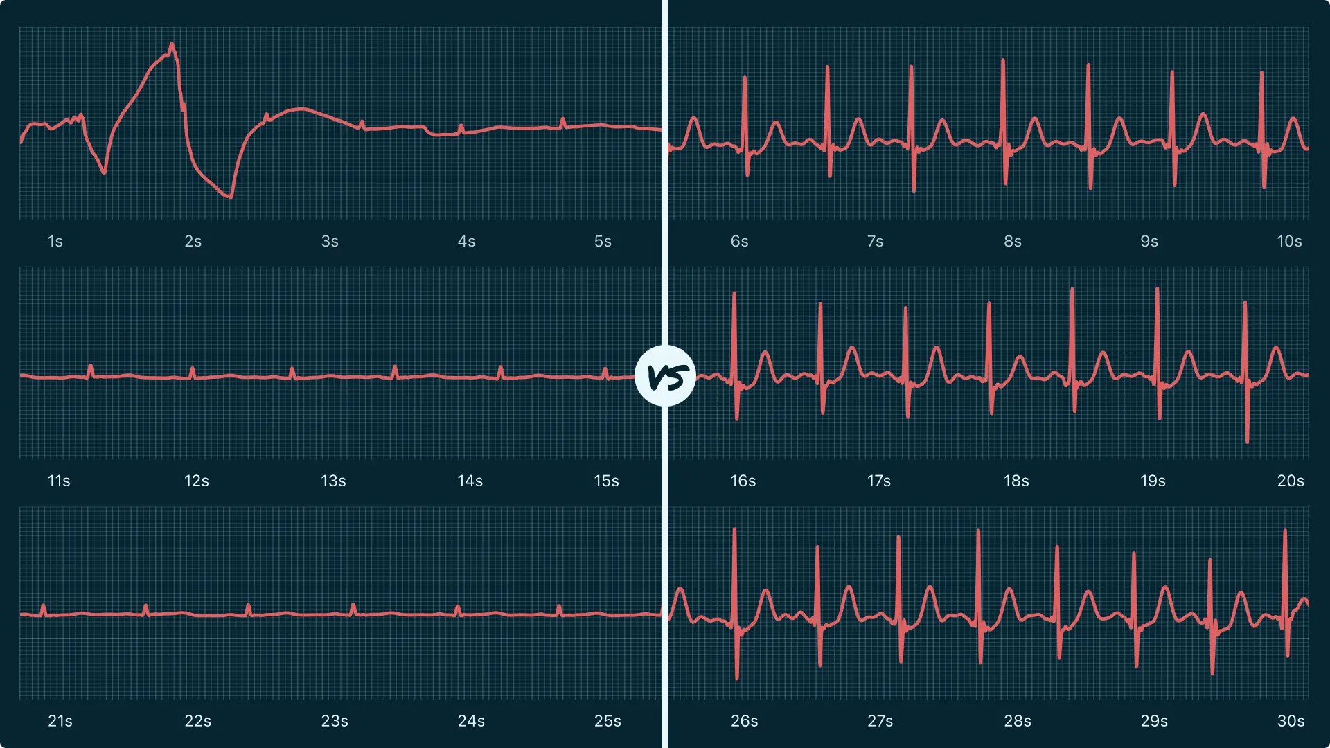 Low Voltage Vs. Sinus Rhythm on Your Watch ECG Qaly